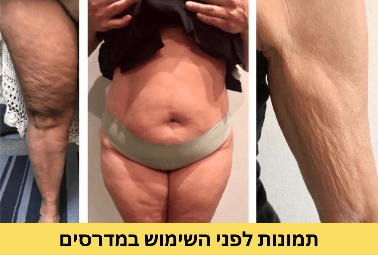 שימוש במדרסים